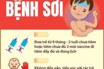 THÔNG BÁO: VỀ VIỆC PHÒNG CHỐNG BỆNH SỞI